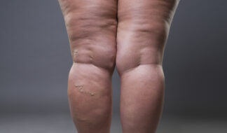 Lipedema - dr guilherme